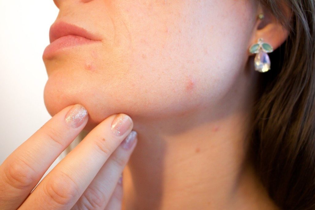 comment atténuer une cicatrice naturellement - cicatrice acné - pranaloe boutique en ligne de cosmétiques bio